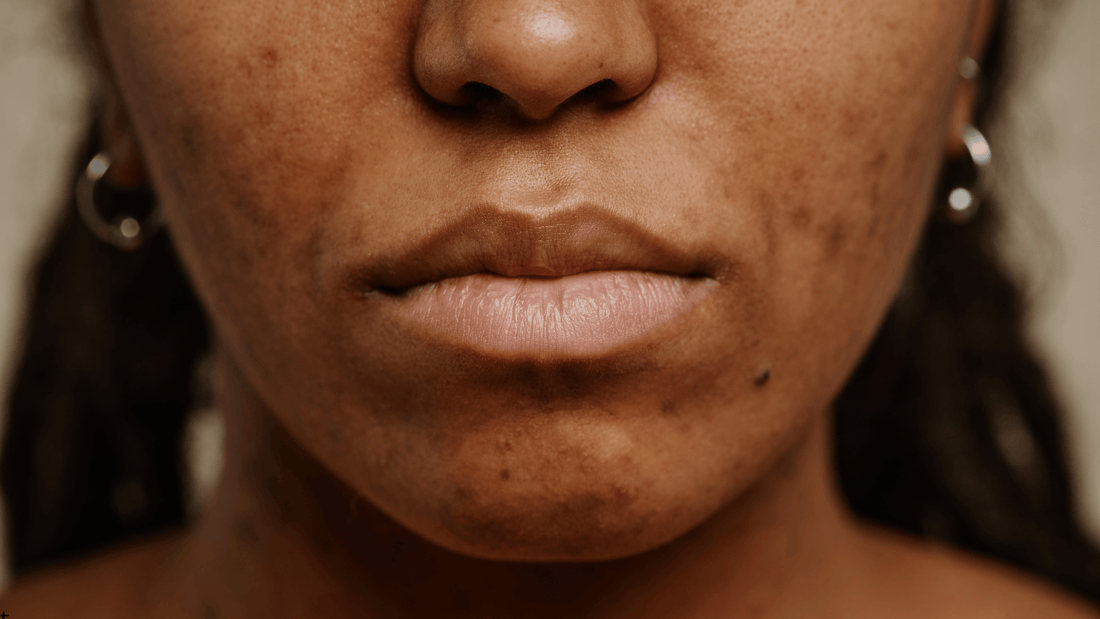 Närbild på akneärr i ansiktet före microneedling-behandling