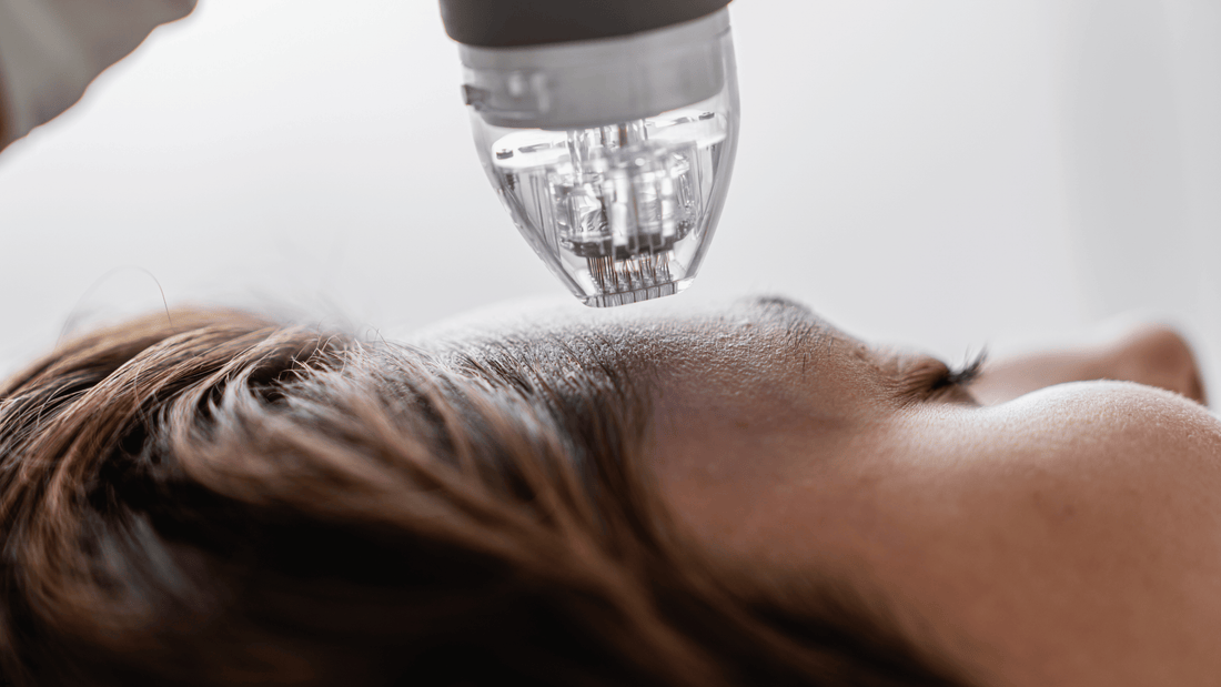 Microneedling-behandling i ansiktet med dermapen som stimulerar kollagenproduktion och förbättrar hudens struktur